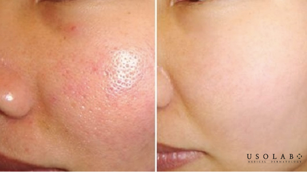 Da mụn nên rửa mặt bằng nước ấm hay lạnh thì tốt hơn