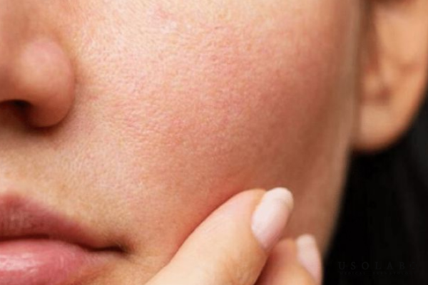 Dấu hiệu cho thấy da nhạy cảm đang thiếu ẩm nghiêm trọng