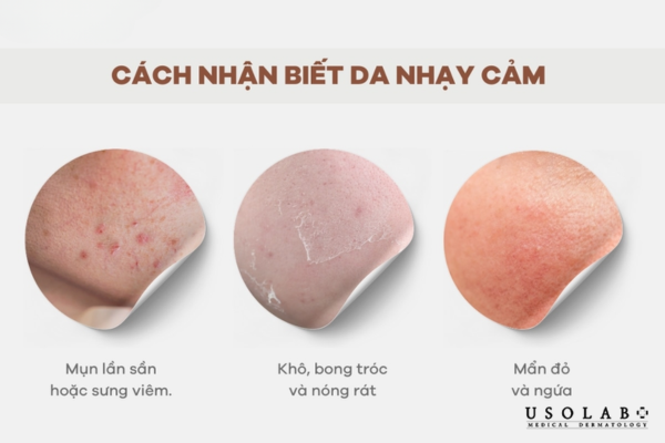 Da nhạy cảm khác da yếu và da đang kích ứng thế nào? Da nhạy cảm khác da yếu và da đang kích ứng thế nào?