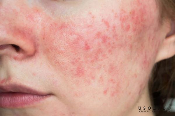 Kem dưỡng ẩm cho da nhạy cảm phù hợp với nhiều tình trạng da khác Kem dưỡng ẩm cho da nhạy cảm phù hợp với nhiều tình trạng da khác