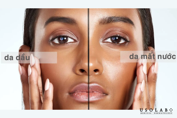 Da có thể tiết nhiều dầu trên bề mặt nhưng bên trong lại thiếu nước do hàng rào bảo vệ da suy yếu Da có thể tiết nhiều dầu trên bề mặt nhưng bên trong lại thiếu nước do hàng rào bảo vệ da suy yếu