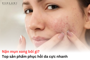 nặn mụn xong bôi gì