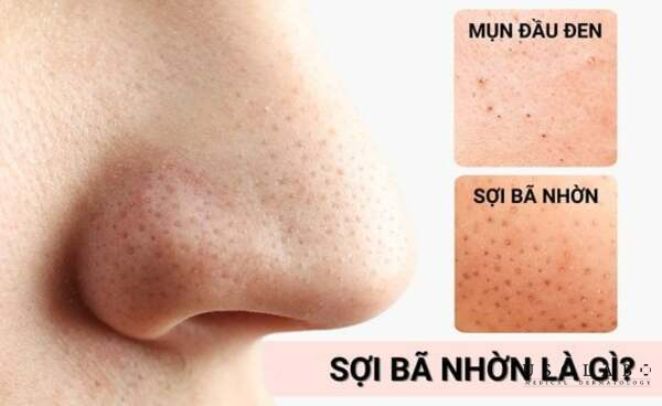 Sợi bã nhờn (Sebaceous Filaments) là những cấu trúc hoàn toàn tự nhiên trong da