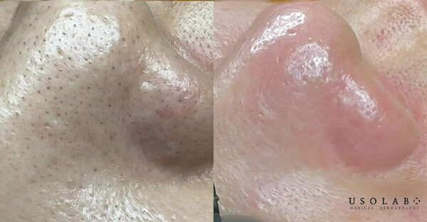 Sợi bã nhờn ở mũi là cơ chế tự nhiên của da nên không thể “biến mất hoàn toàn”