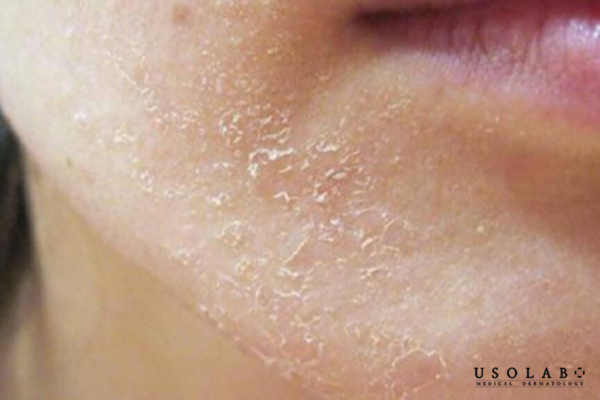 Da khô có hàng rào bảo vệ tự nhiên yếu hơn các loại da khác do thiếu hụt lipid và ceramide