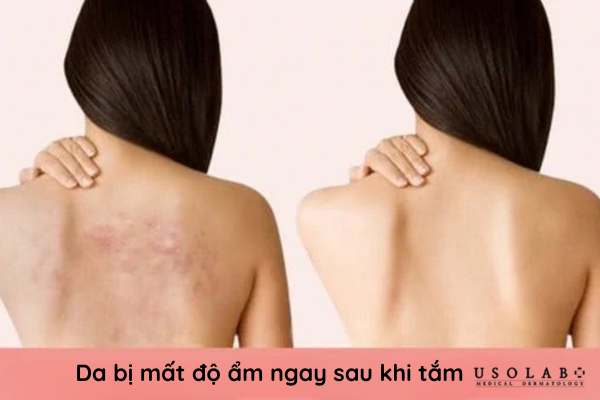 Da thường có xu hướng khô và căng rát sau khi tắm do lớp màng lipid Da thường có xu hướng khô và căng rát sau khi tắm do lớp màng lipid