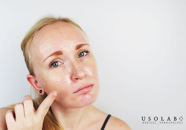 Hiện tượng sáng ngủ dậy mặt bóng dầu thường là phản ứng bình thường của da Hiện tượng sáng ngủ dậy mặt bóng dầu thường là phản ứng bình thường của da