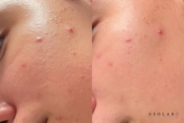 Da nhạy cảm – da yếu Da nhạy cảm – da yếu