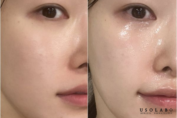 Thoa kem dưỡng ẩm ngay khi serum còn ướt