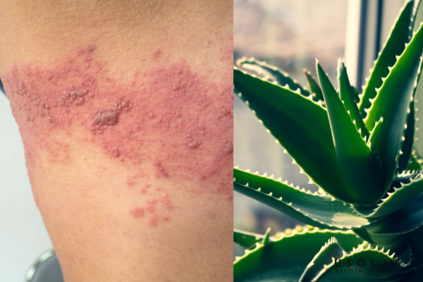 Nguy cơ nhiễm khuẩn khi dùng nha đam tươi Nguy cơ nhiễm khuẩn khi dùng nha đam tươi