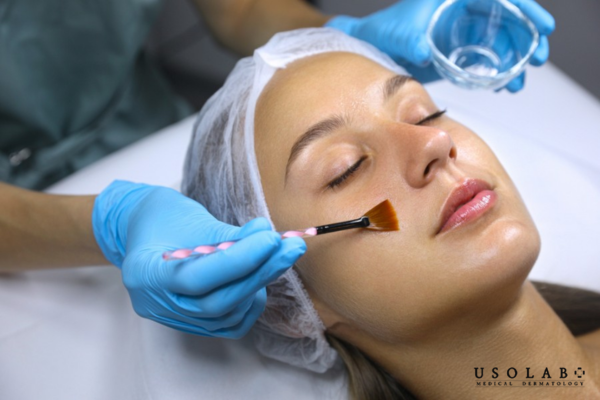 Da sau peel, laser, treatment Da sau peel, laser, treatment