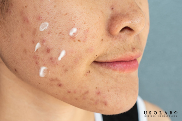 Thuốc trị mụn nên được thoa trước serum trên nền da sạch và khô