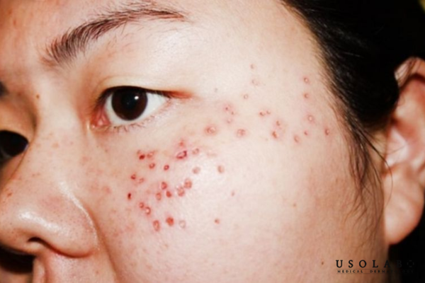 3–5 ngày đầu sau khi đốt tàn nhang: Giai đoạn da đang tổn thương 3–5 ngày đầu sau khi đốt tàn nhang: Giai đoạn da đang tổn thương