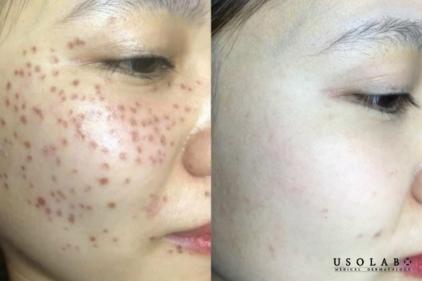 Sau 1 tháng: Giai đoạn xử lý vết thâm sau khi đốt tàn nhang Sau 1 tháng: Giai đoạn xử lý vết thâm sau khi đốt tàn nhang