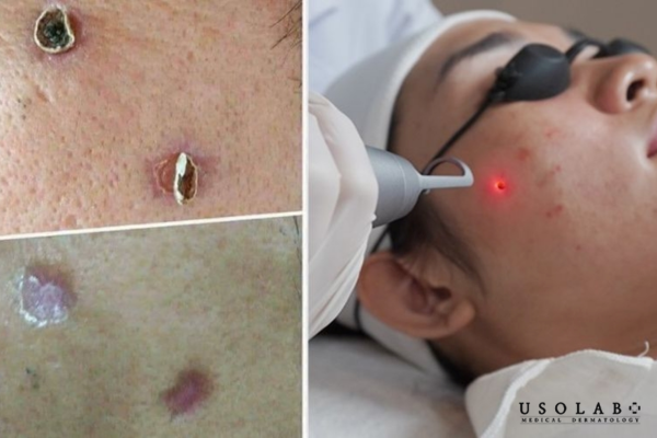 Bóc vảy hoặc cạy mài sớm là sai lầm nghiêm trọng nhất khi thực hiện Bóc vảy hoặc cạy mài sớm là sai lầm nghiêm trọng nhất khi thực hiện