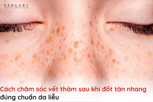 cách chăm sóc vết thâm sau khi đốt tàn nhang