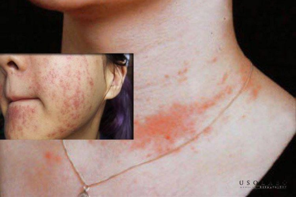 Thủy ngân đi kèm các biểu hiện như mỏng da, bong tróc, châm chích,