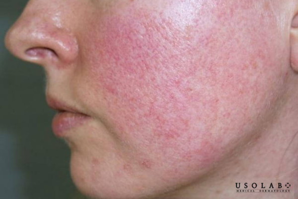 Là làn da bị tổn thương do sử dụng kéo dài hoặc lạm dụng các sản phẩm chứa corticoid