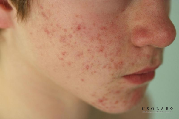 Biến đổi mạnh mẽ nhất dưới tác động của hormone sinh dục, đặc biệt là androgen