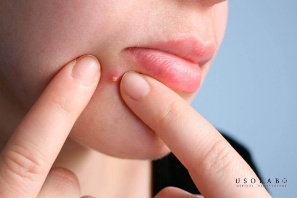 Dùng chung sản phẩm của người lớn hoặc da treatment: