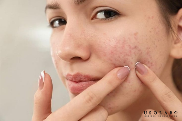 Nguy cơ nhiễm khuẩn và nhiễm trùng da, dễ gây kích ứng và phản ứng dị ứng