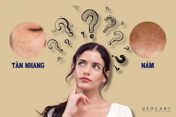 Nhiều người nhầm lẫn giữa nám và tàn nhang vì biểu hiện bề ngoài khá tương đồng