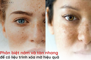 phân biệt nám và tàn nhang