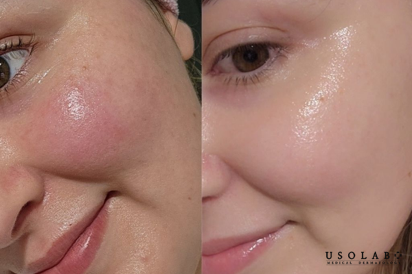 Điều tiết bã nhờn một cách êm dịu, làm dịu nhanh các dấu hiệu kích ứng