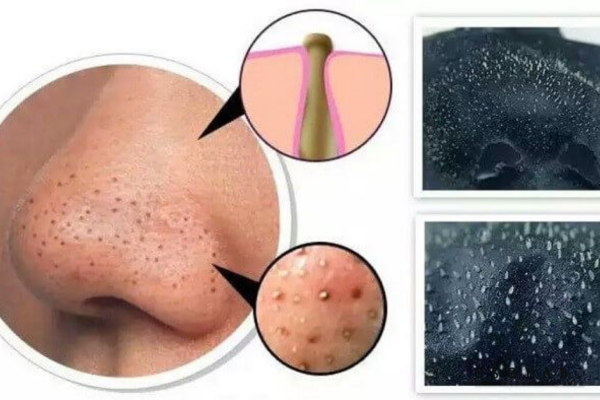 serum trị lỗ chân lông to và mụn đầu đen