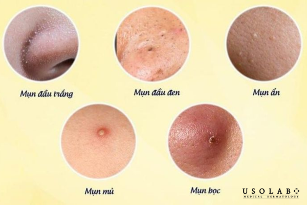 Da mụn sau khi dùng treatment mạnh, da dầu mụn mất cân bằng nước – dầu