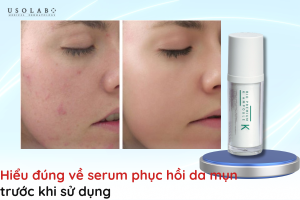 serum phục hồi da mụn