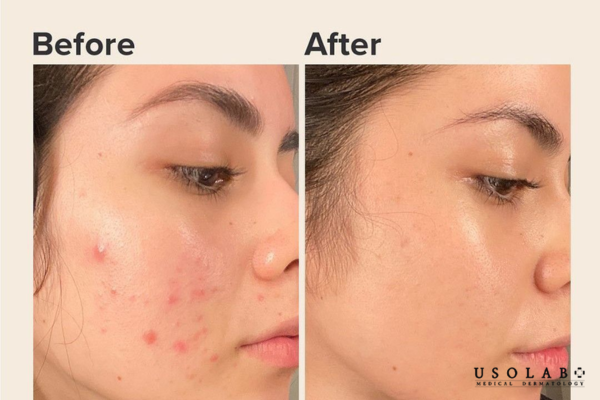 serum trị lỗ chân lông to và mụn đầu đen