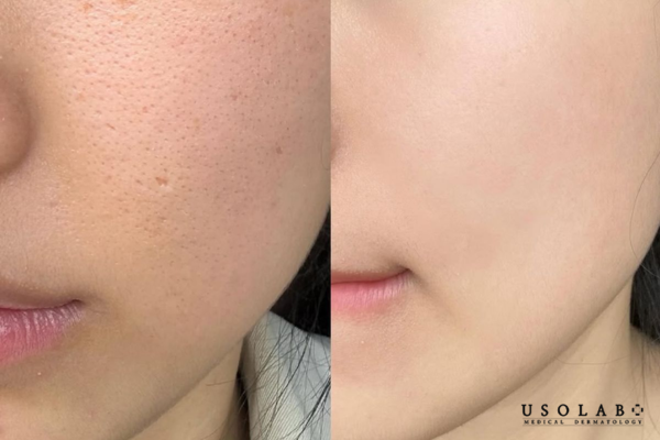 serum trị lỗ chân lông to và mụn đầu đen