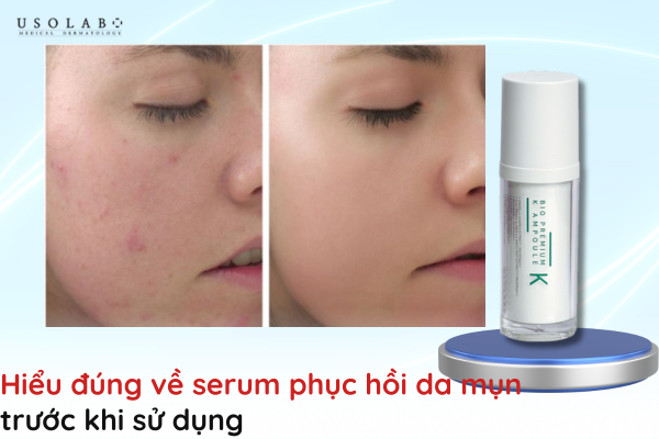 serum phục hồi da mụn