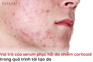 serum phục hồi da nhiễm corticoid