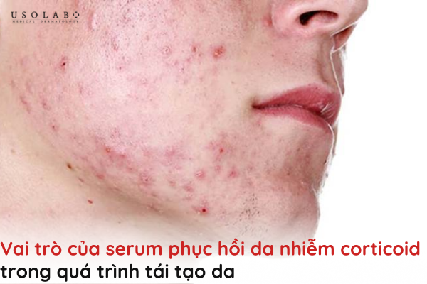serum phục hồi da nhiễm corticoid