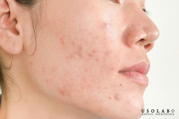 Da yếu là tình trạng làn da suy giảm chức năng bảo vệ tự nhiên