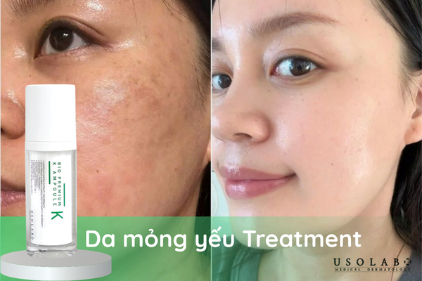 Serum phục hồi da yếu hoàn toàn có thể và nên dùng chung với treatment