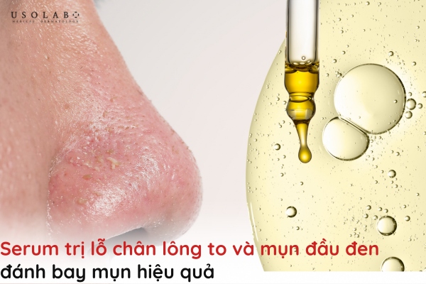 serum trị lỗ chân lông to và mụn đầu đen