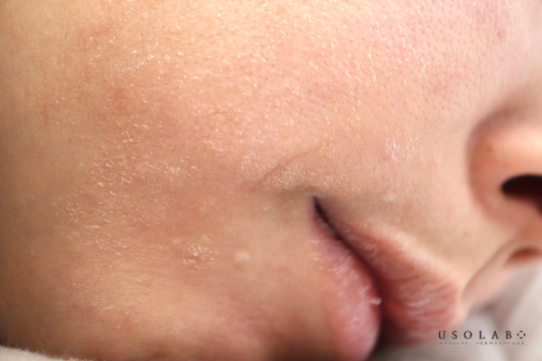 Là cảm giác căng rít sau khi rửa mặt, da bong tróc nhẹ, sần sùi và kém mịn