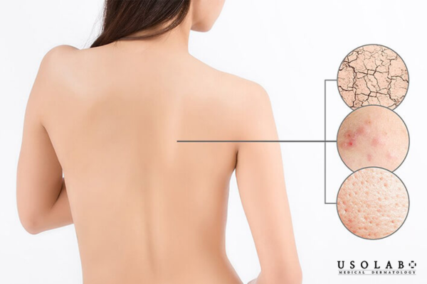 Cho body là giải pháp làm sạch da toàn thân tương đối dịu nhẹ Cho body là giải pháp làm sạch da toàn thân tương đối dịu nhẹ