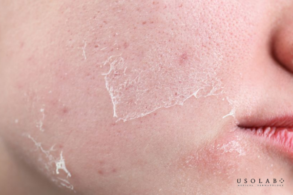 Peel da tại nhà có thể bong nhẹ hoặc không bong rõ rệt