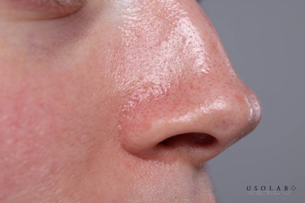 Da dầu, da hỗn hợp thiên dầu, da có mụn đầu đen, mụn cám nhẹ