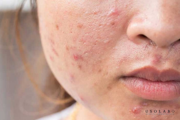 Dùng mặt nạ thải độc có bị đẩy mụn không