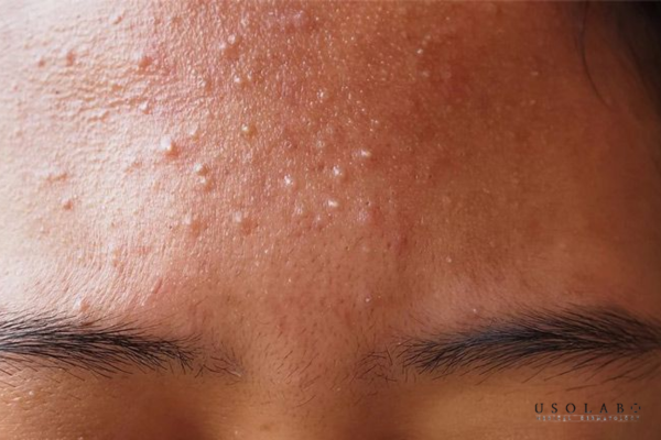 Thâm mụn và da xỉn màu thường liên quan đến quá trình tái tạo