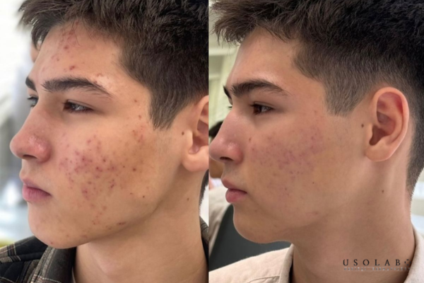 Việc có nên peel da không khi đang bị mụn phụ thuộc vào loại mụn và mức độ viêm