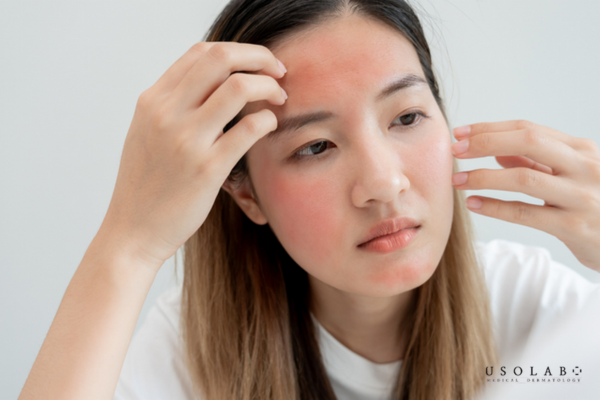 Vì tạo ra một tổn thương có kiểm soát lên lớp biểu bì nhằm kích thích tái tạo tế bào mới Vì tạo ra một tổn thương có kiểm soát lên lớp biểu bì nhằm kích thích tái tạo tế bào mới