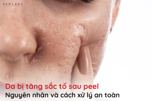 da bị tăng sắc tố sau peel