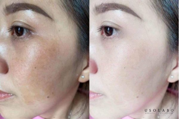 Trường hợp nặng có thể kéo dài nhiều tháng Trường hợp nặng có thể kéo dài nhiều tháng