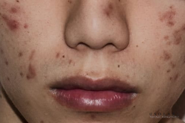 Da bị tăng sắc tố sau peel do PIH thường xuất hiện tại đúng vùng điều trị Da bị tăng sắc tố sau peel do PIH thường xuất hiện tại đúng vùng điều trị